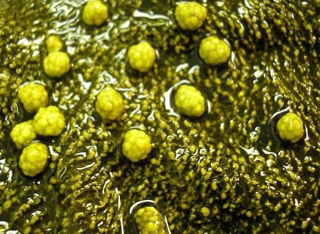 gallbladderliver Chronology gallbladder stones